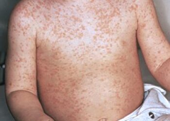 Sociedad Dermatología pide ciudadanía no auto medicarse en sarampión
