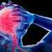 Mancuspias, migrañas y metáforas: instrucciones para entender la migraña según Cortázar
