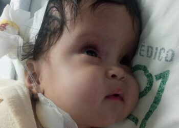Piden ayuda para operar de la cabeza una bebé de tres meses